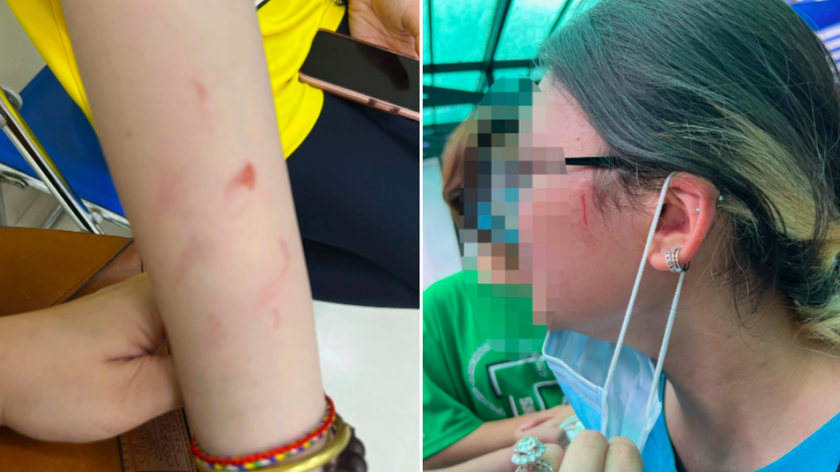 Hình ảnh học sinh bị thương trong vụ xô xát tại trường quốc tế TP HCM.