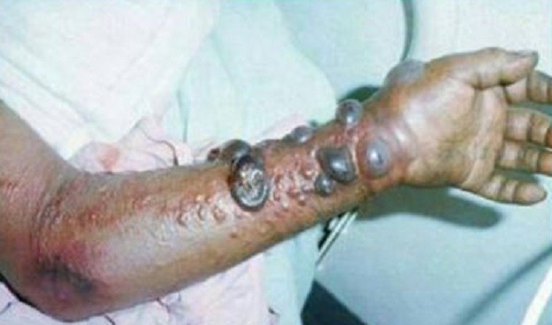 Bàn tay bệnh nhân nhiễm virus Ebola