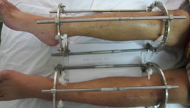 Kéo dài chân là một kỹ thuật phức tạp đi kèm với nó là vô số biến chứng