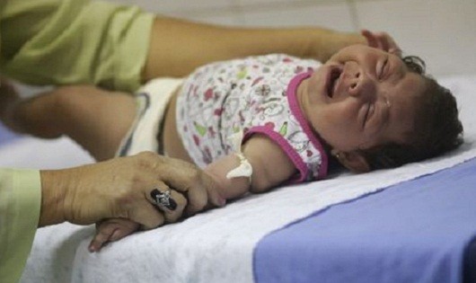 Một em bé bị bệnh đầu nhỏ ở Brazil. Ảnh: Reuters