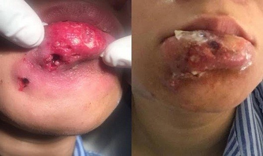  Bác sỹ BV Việt Nam – Cu Ba nói về trường hợp biến chứng sau khi tiêm filler môi