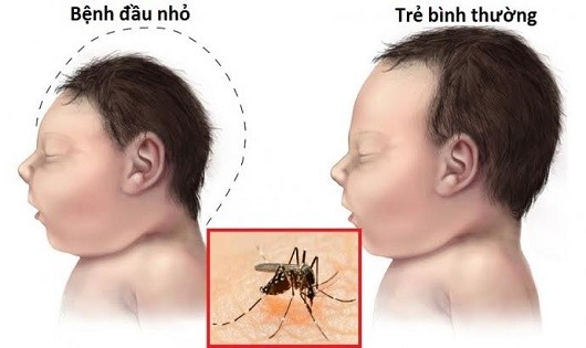 Zika gây dị tật đầu nhỏ.