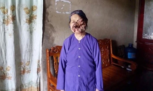 Nỗi đau khổ của cụ bà 3 năm  sống chung với khuôn mặt biến dạng 
