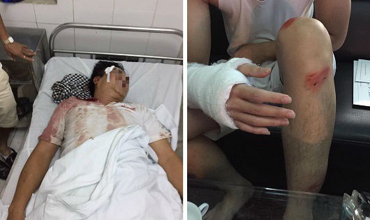 Ông D bị đánh bất tỉnh được đưa vào bệnh viện cấp cứu (ảnh trái) và anh N bị đánh gãy tay phải được bác sĩ bó bột (Ảnh gia đình nạn nhân cung cấp)