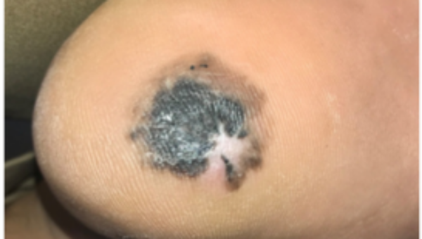 Phát hiện ung thư da nhờ chấm đen ở gót chân 