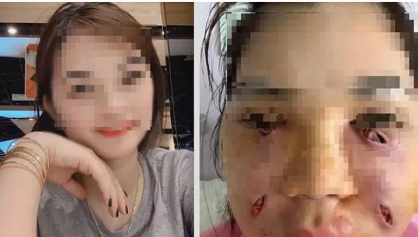 Nữ sinh bị biến dạng khuôn mặt vì làm đẹp bằng bơm mỡ tự thân