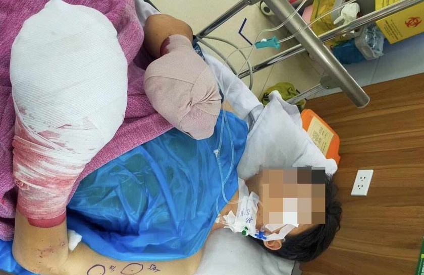 Bé trai 14 tuổi bị nát hai bàn tay sau tiếng nổ lớn (ảnh T.K)