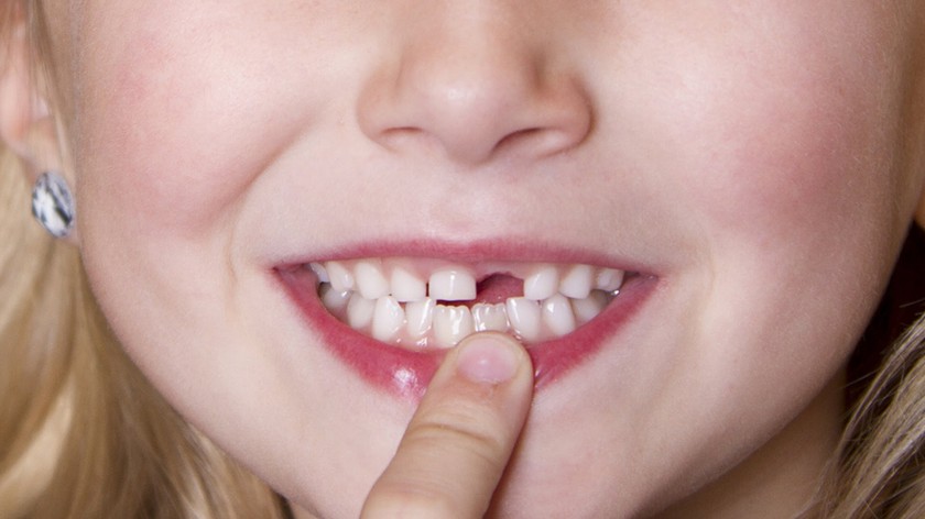 Khi mới mọc, răng của nhiều trẻ không được "trât tự" như mong muốn 