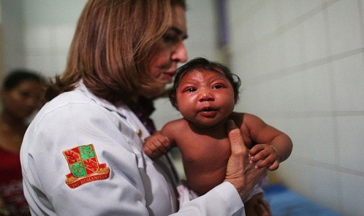 Một em bé mắc chứng đầu nhỏ do nhiễm Zika. 