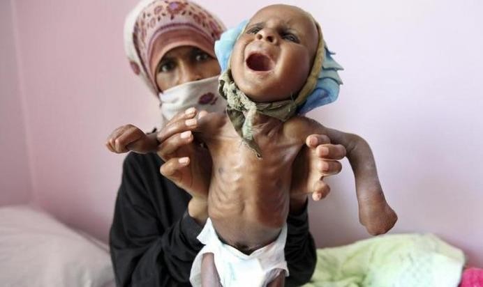 85.000 trẻ dưới 5 tuổi ở Yemen chết vì 'đói'