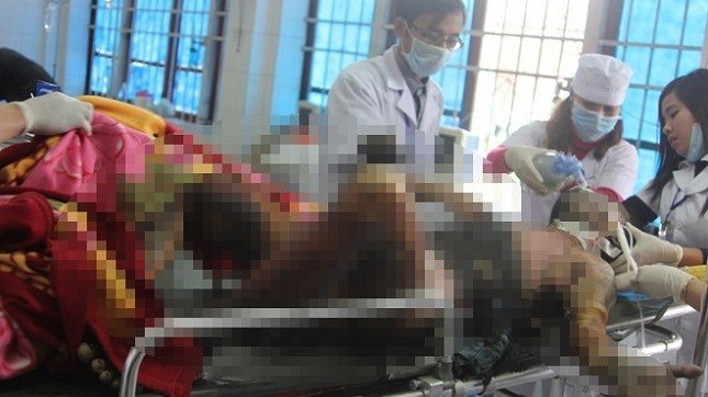 Hồ Sỹ Huy bị cháy toàn thân đang được cấp cứu tại bệnh viện