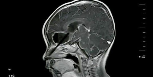 Ảnh chụp X-Quang đoạn đũa mắc trong não cậu bé.