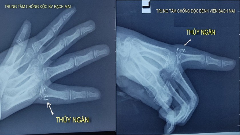 Hình ảnh chụp x-quang vết thương ở ngón tay của cháu bé N.N.Y. Ảnh: Mai thanh