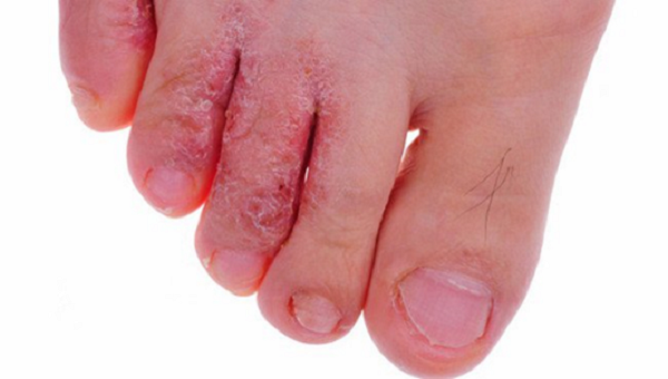 Các bệnh nấm trên da rất dễ sinh sôi và phát triển trong thời tiết nồm ẩm. Ảnh: minh họa.