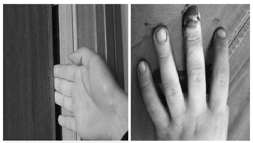 Một bé trai 6 tuổi đã bị tổn thương ngón tay vì kẹp ngón tay vào cánh cửa gỗ trong lúc chơi đùa. Ảnh: Bác sĩ cung cấp