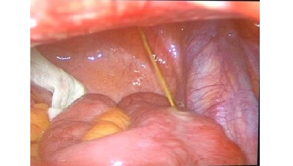 Hình ảnh chiếc tăm tre trong thành quai ruột non của bệnh nhân. Ảnh: BVCC