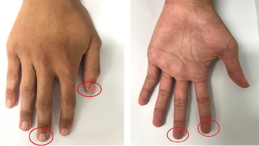 Các đám sắc tố ở tay bệnh nhân trước khi phẫu thuật (Ảnh: BVCC)