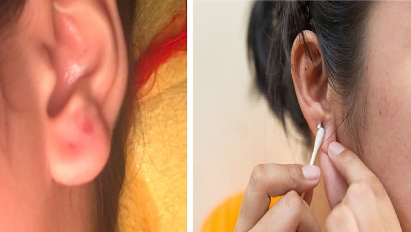 Vài ngày sau bấm lỗ tai ở một tiệm chuyên bán bông tai, tai của bệnh nhân đã bị mưng mủ và phải nhập viện điều trị. Ảnh: BVCC
