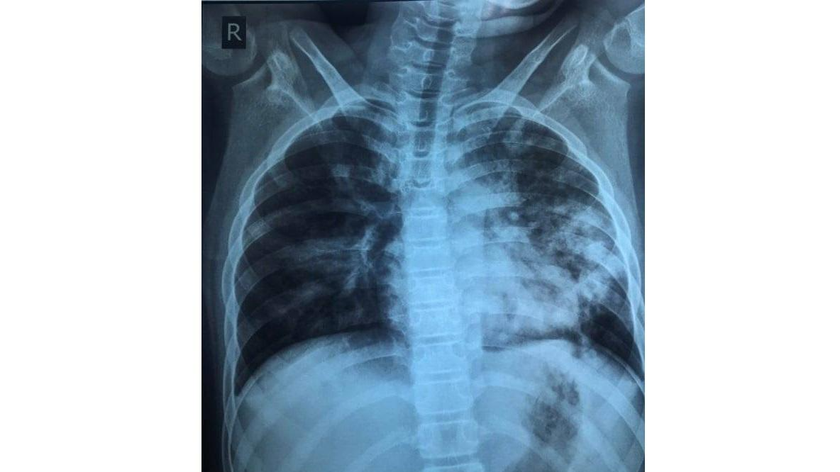XQ của bé lúc nhập viện, tổn thương phổi nặng dù triệu chứng mắc COVID-19 rất nhẹ. Ảnh: BVCC