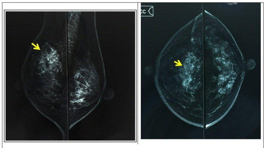 Hình ảnh Xquang vú tháng 1/2022: Hình ảnh khối u lớn vú phải 1/2 trên kích thuocs 4,6x3,0x5,0 cm, nốt lân cận 1,1 cm, bờ không đều, thâm nhiễm mỡ trước da vú. Ảnh: BVCC