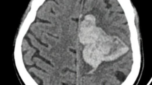 Hình ảnh chụp cắt lớp vi tính sọ não người bệnh. Ảnh: BVCC