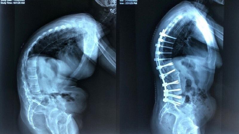 Hình ảnh chụp Xquang trước và sau phẫu thuật. Ảnh: BVCC
