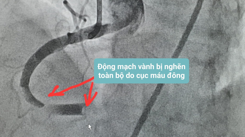 Ảnh chụp Xquang động mạch vành bị nghẽn của bệnh nhân. Ảnh: BVCC