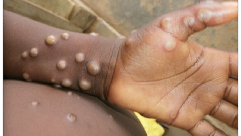 Bệnh đậu mùa khỉ. Ảnh: Trung tâm Kiểm soát Dịch bệnh Nigeria