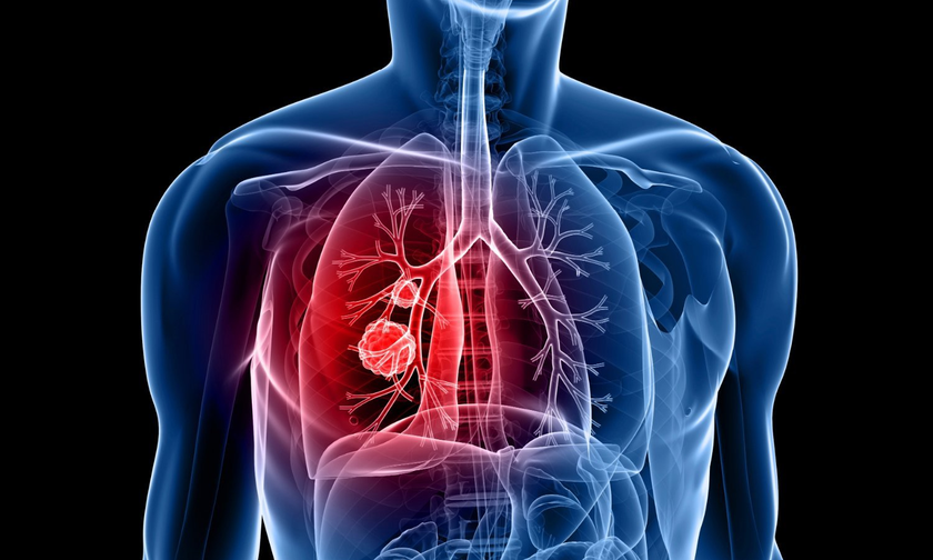 Ung thư phổi là bệnh lý ung thư thường gặp nhất. Ảnh: minh họa.