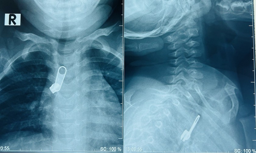 Hình dị vật móc khóa kéo trong đường thở của bé. Ảnh: BVCC