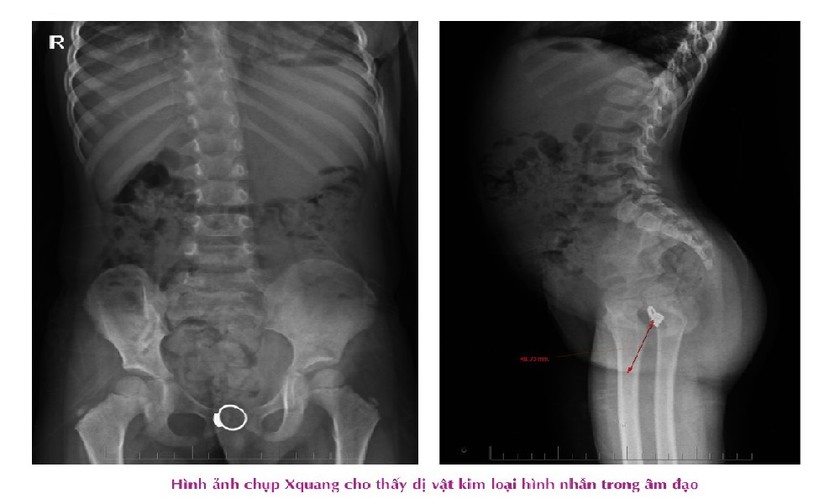 Hình ảnh X-quang thấy rõ chiếc nhẫn trong vùng kín của trẻ. Ảnh: BVCC.