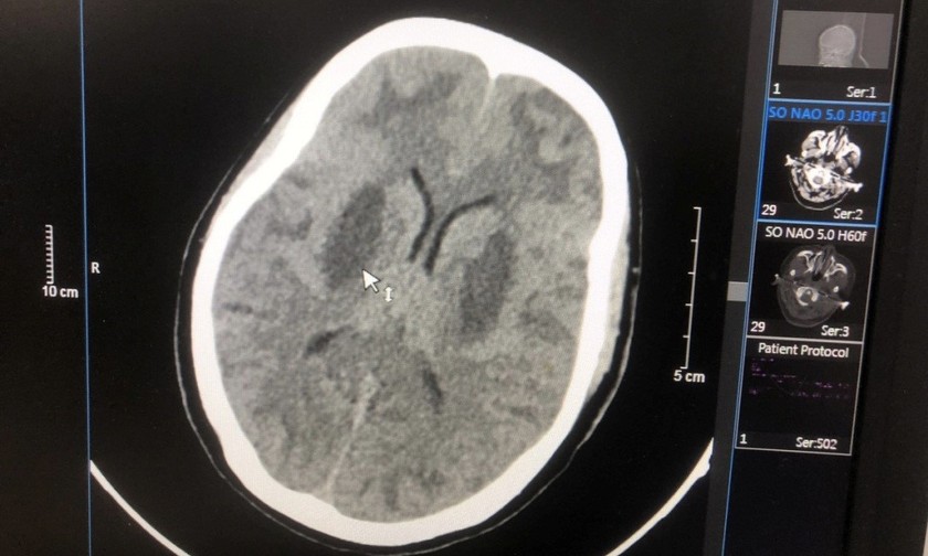 Hình ảnh tổn thương não của bệnh nhân Triệu Văn N. Ảnh: BVCC