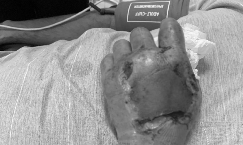 Sau 7 ngày tự đắp thuốc chữa rắn cắn, bàn tay của bệnh nhân đã bị hoại tử. Ảnh: BVCC
