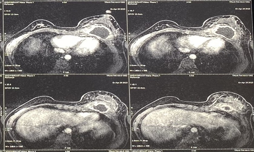 Hình ảnh siêu âm khối áp xe trên vú bệnh nhân. Ảnh: BVCC