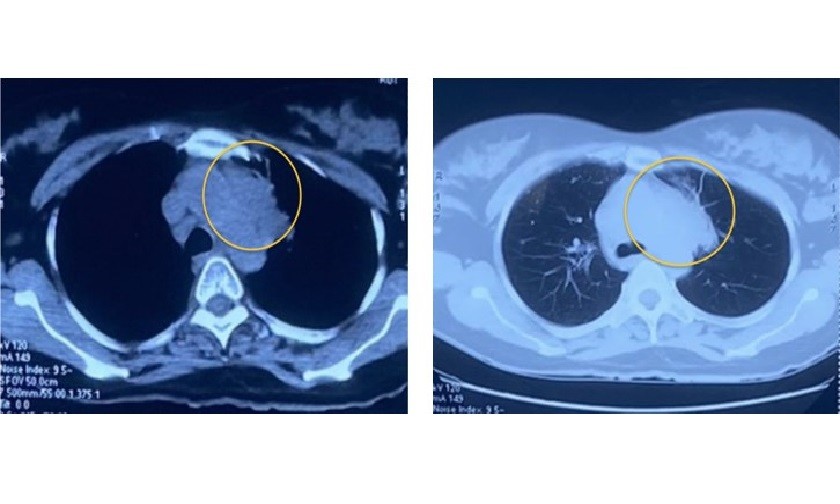 Hình ảnh chụp cắt lớp vi tính lồng ngực: Khối mờ trung tâm thuỳ trên phổi trái (vòng tròn màu vàng). Ảnh: BVCC
