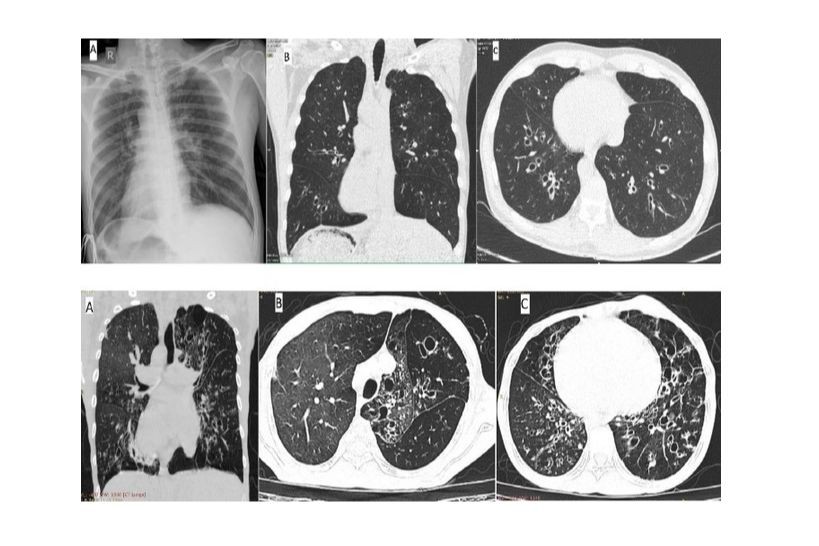 Hình ảnh tim, mạch máu đảo ngược quay sang phải và giãn phế quản ở cả 2 phổi trên phim ở bệnh nhân Kartagener. Ảnh BVCC