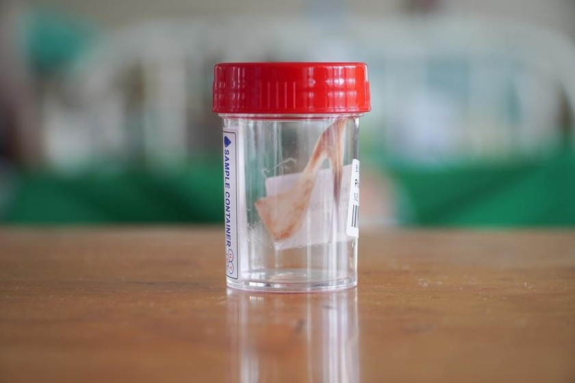 Hình ảnh miếng xương chim cút bị “mắc kẹt” trong người bệnh nhân P.V.T (sinh năm 1942, tại Đồng Nai) được BS khoa Tai Mũi Họng bệnh viện Chợ Rẫy gắp ra. Ảnh: BVCC