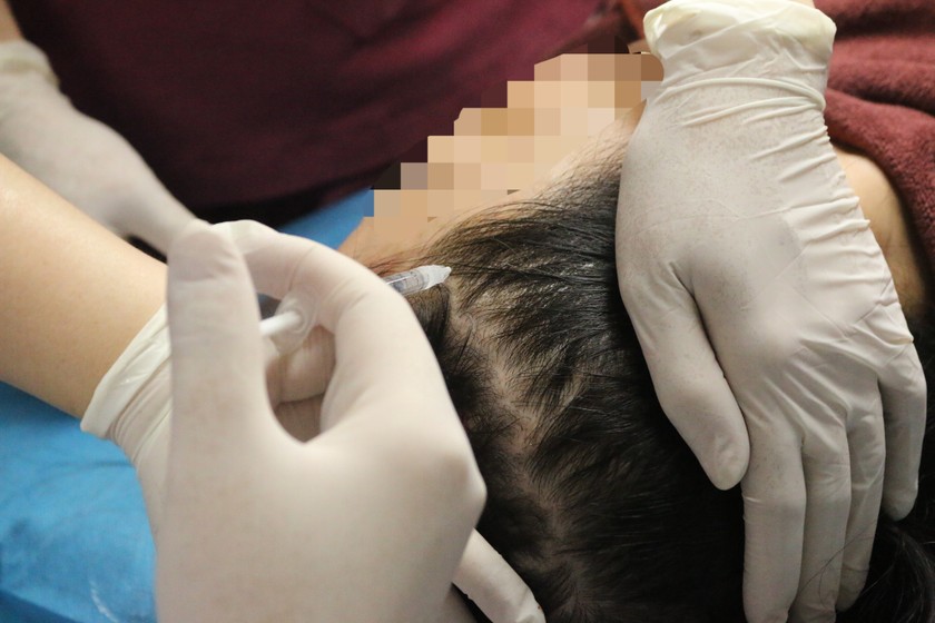 Bệnh nhân điều trị rụng tóc tại Bệnh viện Da liễu Trung ương. Ảnh: Ngọc Nga