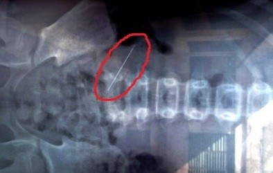  Hình chụp X-quang bụng bé gái bị cây kim 5cm đâm vào bụng. Ảnh: L.N