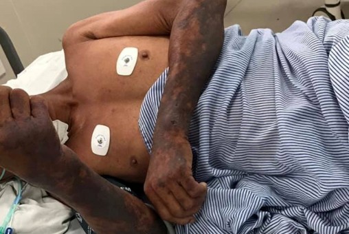 Bệnh nhân C. bị nổi ban tím ở 2 cánh tay khi nhập viện. Ảnh: Bắc Lê