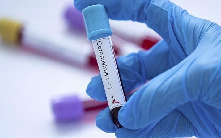 Ống xét nghiệm cho kết quả dương tính với virus SARS-CoV-2 gây bệnh Covid-19. Ảnh: Anadolu.
