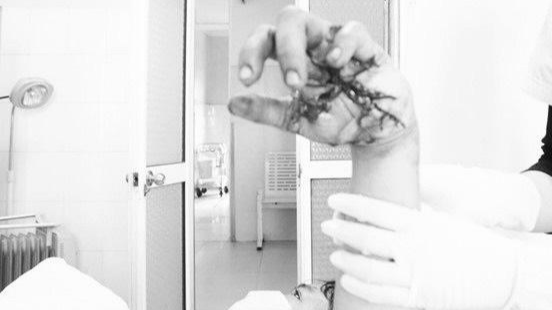 Bàn tay người bệnh sau khi được phẫu thuật bảo tồn Ảnh: BVCC