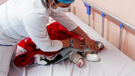 Trẻ bị bỏng nặng ở phần chân khi xông phòng COVID Ảnh: BVCC