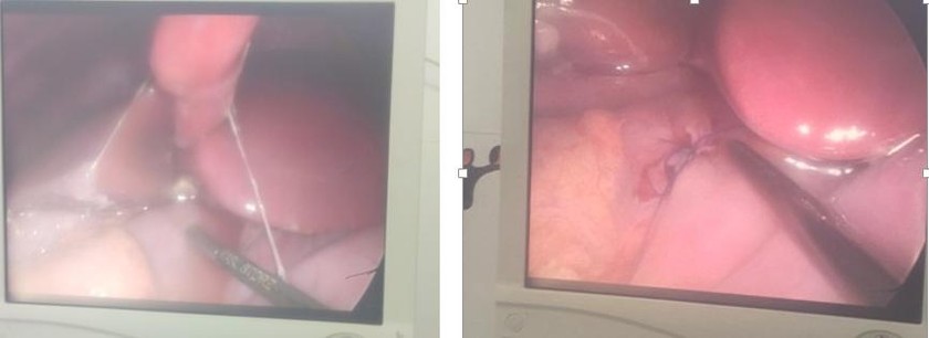 Lỗ thủng mặt trước môn vị phát hiện trong mổ nội soi (trái) và tiến hành khâu lỗ thủng bằng phương pháp mổ nội soi (phải) Ảnh: BVCC