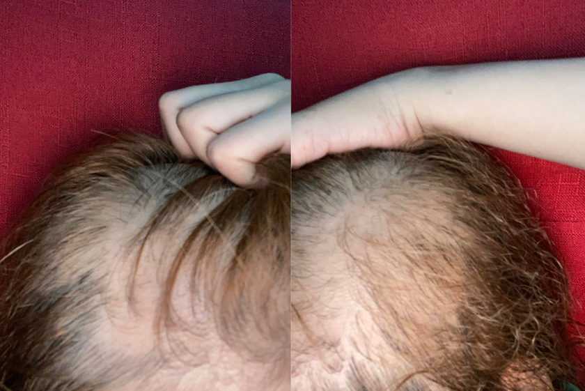 Tình trạng rụng tóc hiện tại của Thảo Thanh (Ảnh: Nhân vật cung cấp)