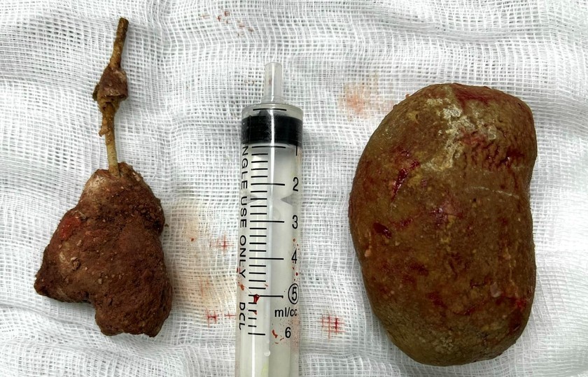 2 viên sỏi kích thước khủng được lấy ra sau phẫu thuật (phải) Ảnh: BVCC