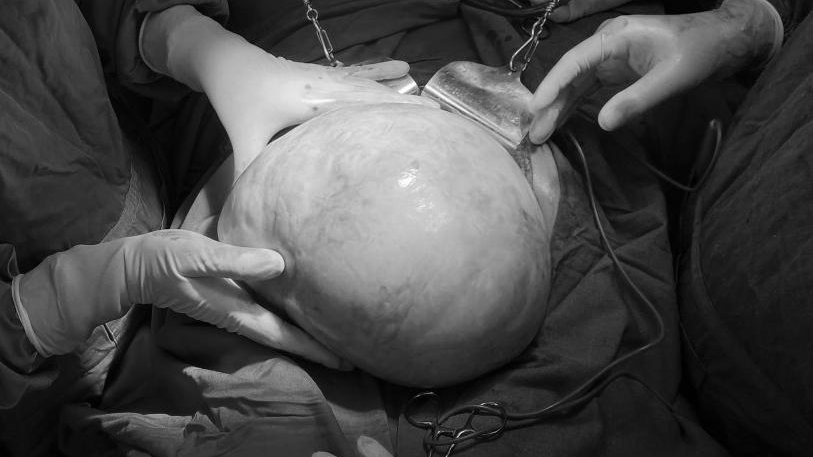 Khối u nang buồng trứng "khổng lồ" được lấy ra khỏi bụng bệnh nhân Ảnh: BVCC