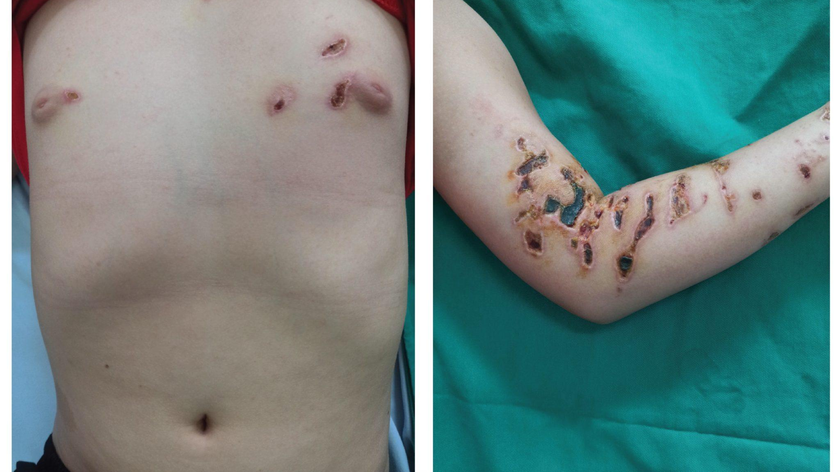 Nhiều tổn thương loét da, ranh giới rõ, trên có nhiều giả mạc đen bẩn vùng cánh tay, ngực sau khi tiếp xúc với sứa biển 14 ngày - Ảnh: BVCC