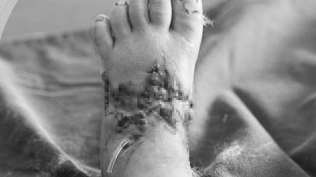 Bàn chân dập nát do bị kẹt cửa của bệnh nhi - Ảnh: BVCC