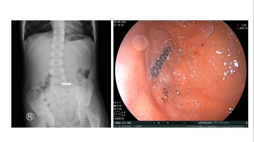 Hình ảnh Xquang bụng cho thấy các viên bi nam châm “chạy” xuống ruột non, được phối hợp nội soi ổ bụng lên dạ dày gắp ra. Ảnh: BVCC